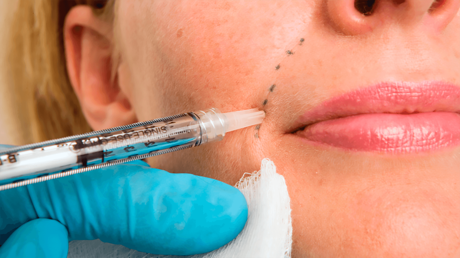 Glatte Haut mit juvederm filler – jetzt bei MorySkin erhältlich