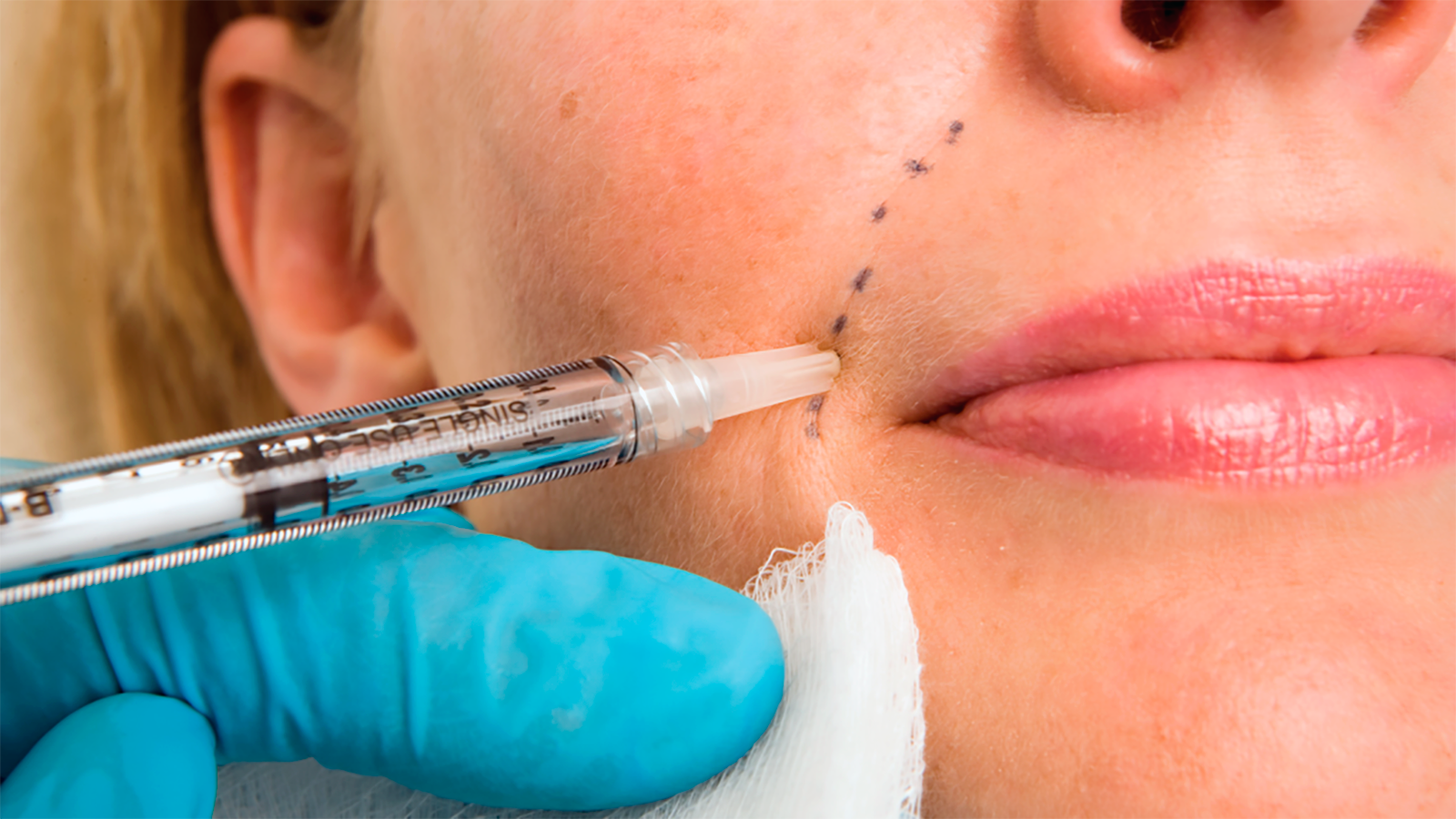 Glatte Haut mit juvederm filler – jetzt bei MorySkin erhältlich